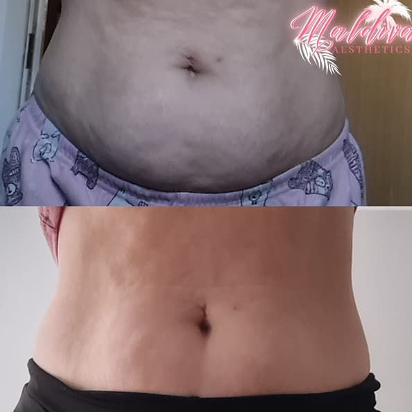 fat dissolving injections