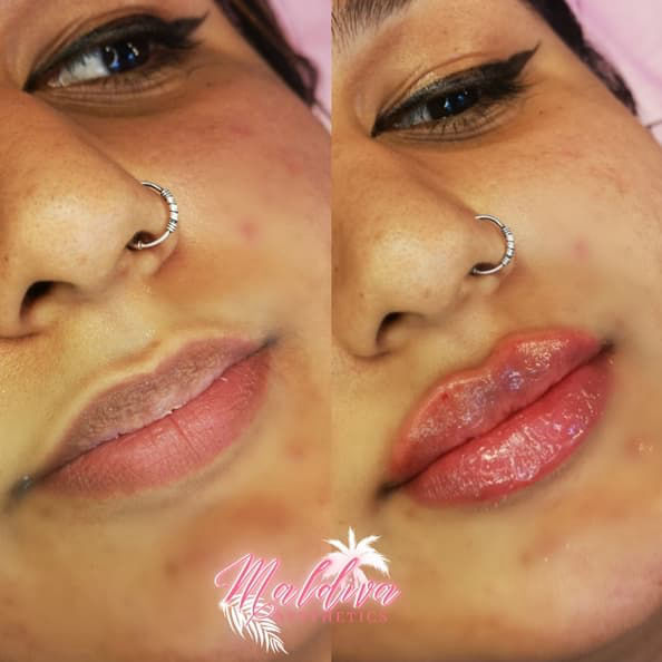permanent lip filler