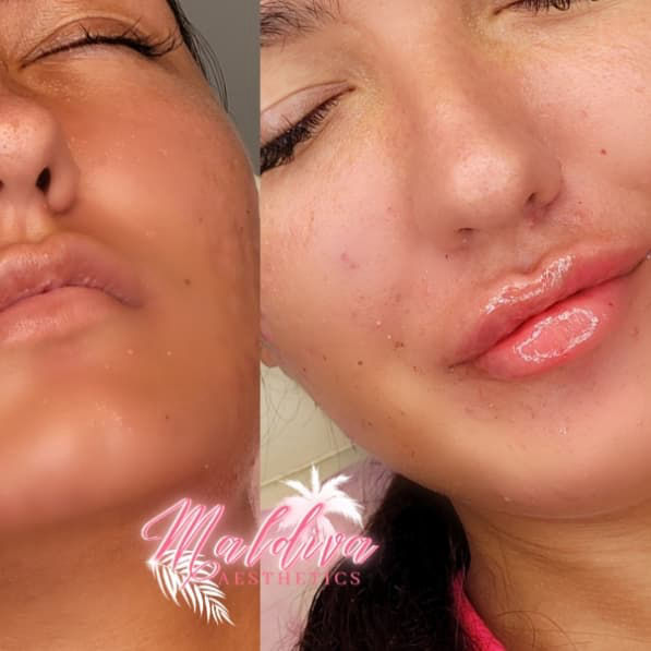 russian technique lip filler