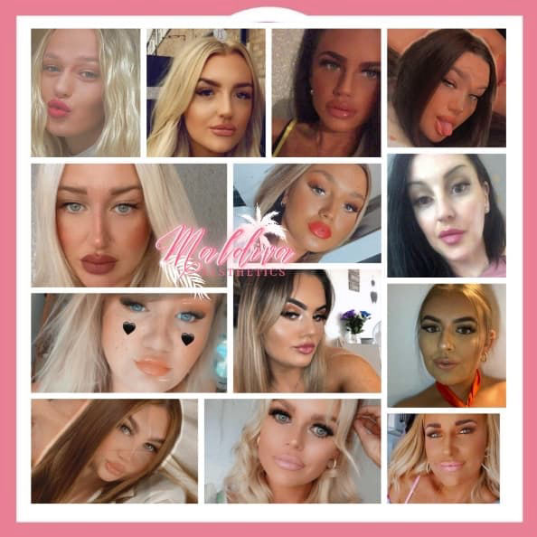 types of lip fillers